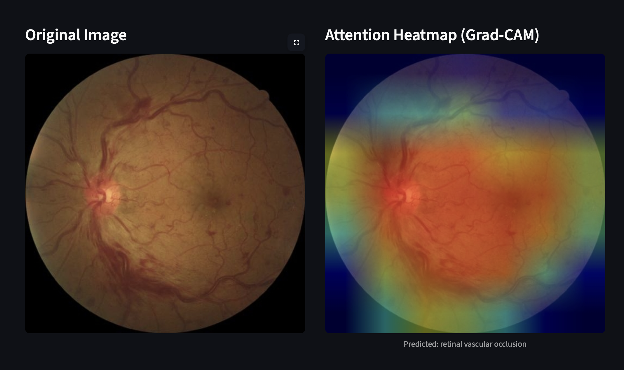 Retinal interface comparing an original fundus image with its Grad-CAM attention heatmap